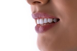 Cost Analysis of Composite Veneers